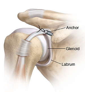 Front view of shoulder joint showing Bankart lesion. Anchors are being placed to repair tear.