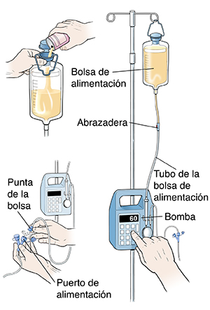 Bomba para sonda de alimentación continua, donde puede verse el tubo de la bolsa de alimentación que conecta la bomba a la bolsa de alimentación que está en el soporte IV. Hay una abrazadera en la mitad del recorrido de los tubos. Recuadro donde pueden verse manos que vierten fórmula en una bolsa de alimentación. Primer plano de manos que insertan el extremo del tubo de la bolsa en el puerto para el tubo de alimentación.