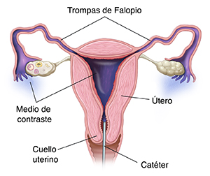 Vista frontal del corte transversal del útero donde se observa un catéter introducido a través del cuello uterino, que libera medio de contraste en el útero y en las trompas de Falopio.